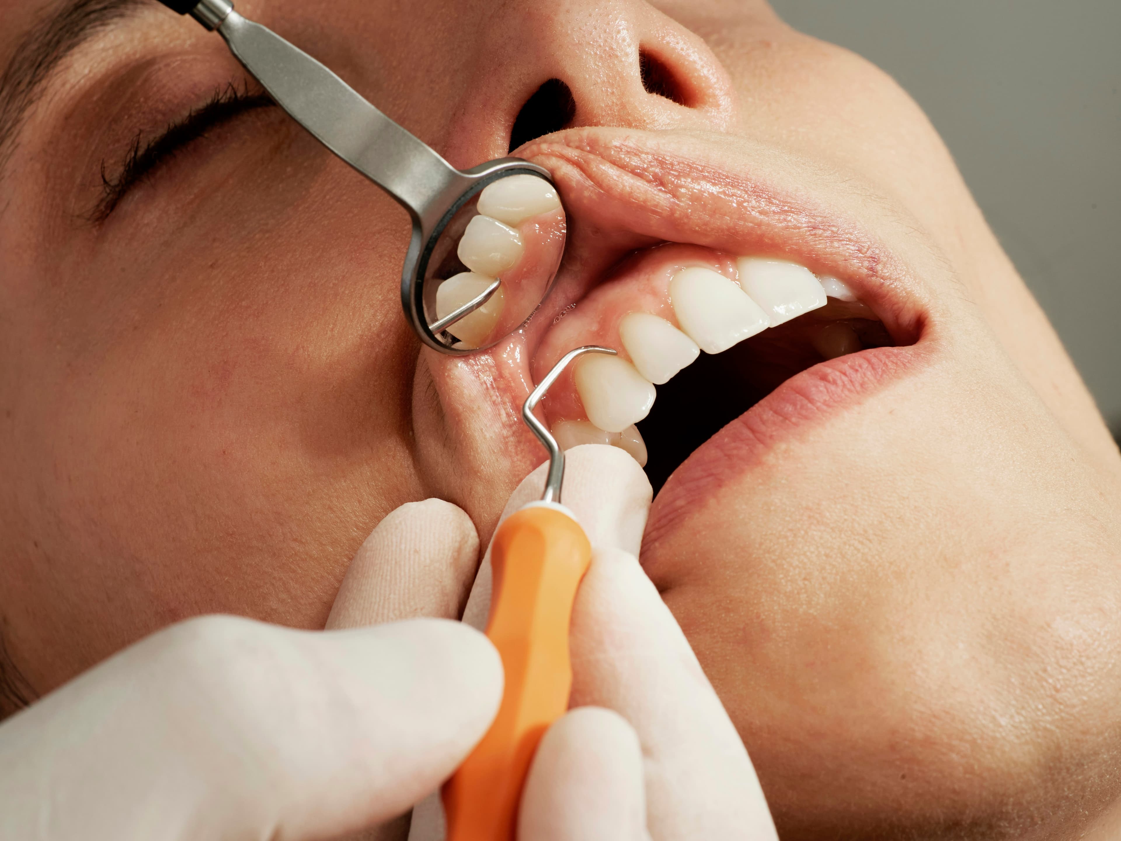 Khám răng với gương và dụng cụ nha khoa
